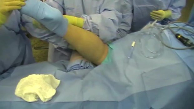 Complex Tibial Plateau Fractures: A Direct Posterior Approach for ...