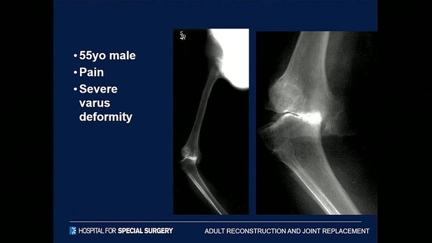 What Is Varus Deformity