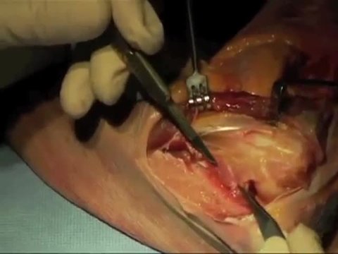 Boyd Approach to the Elbow | Vumedi