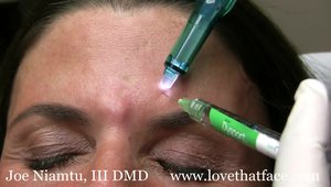 New Vibratory Device for Botox Injections. | Vumedi