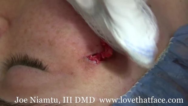 Cosmetic Removal Of Sebaceous Cyst on the Face | Vumedi