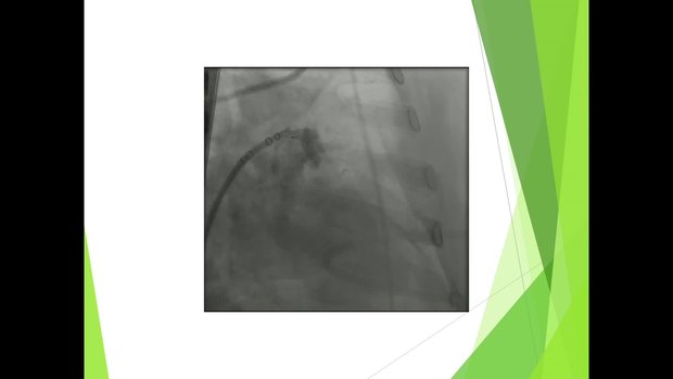 The Watchman Procedure Description: Step by Step | Vumedi