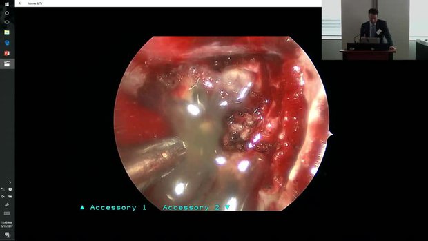 Endoscopic Transplanum, Transtuberculum Approach | Vumedi