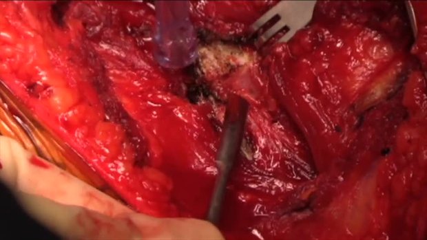 Multiple Rib Non-union: ORIF and Iliac Crest Bone Graft Aspirate | Vumedi