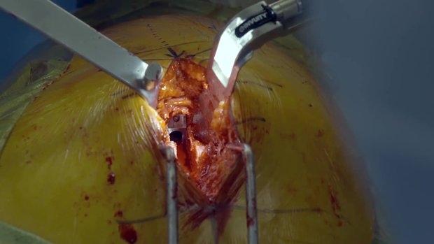 SuperPath® - The Direct Superior Portal Assisted Total Hip Approach ...