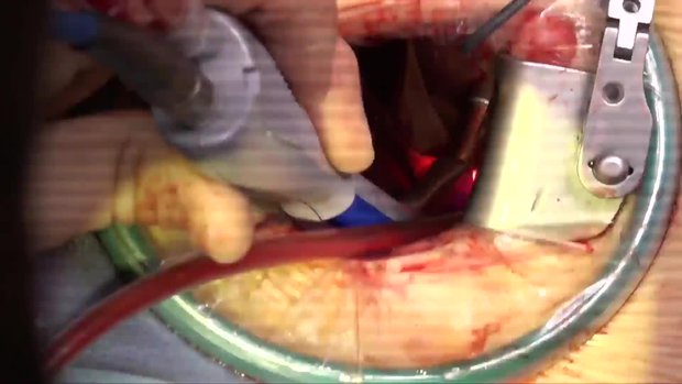 Simplifying Minimally Invasive Mitral Valve Surgery | Vumedi
