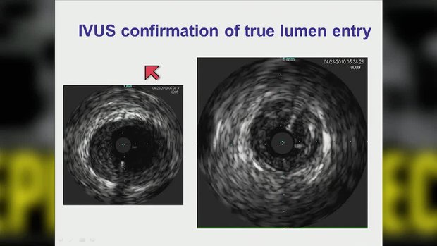 Wire Externalization/Snaring/Guide Extensions In CTO PCI | Vumedi