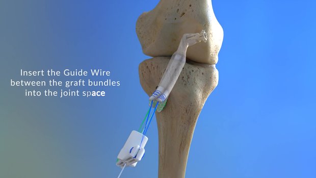 Sheath and Screw Solution for Tibial Fixation in Soft Tissue ACL ...