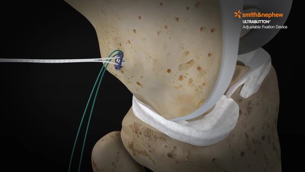 ULTRABUTTON* Device and BIOSURE* REGENESORB Screw for ACL ...
