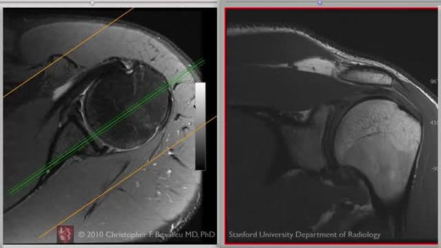 Shoulder MRI Basic Axial Anatomy | Vumedi