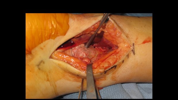 Approaches to Treating Pilon Fractures | Vumedi