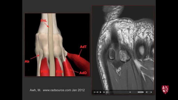 Turf Toe: Anatomy, Imaging, and Evaluation of the Great Toe (Hallux ...