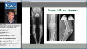 Treatment Options of Unicondylar Knee Osteoarthritis in the Young Adult