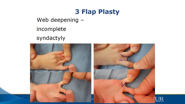 Local Flaps for Hand Coverage | Vumedi