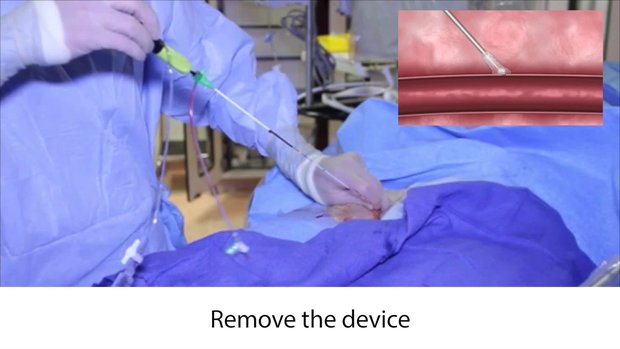 MYNXGRIP Vascular Closure Device Live Deployment | Vumedi