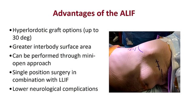 ALIF - Direct Anterior | Vumedi
