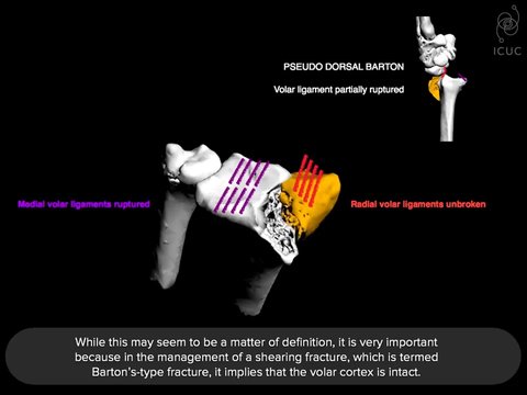 Dorsal Barton's Fractures, do they exist? | Vumedi