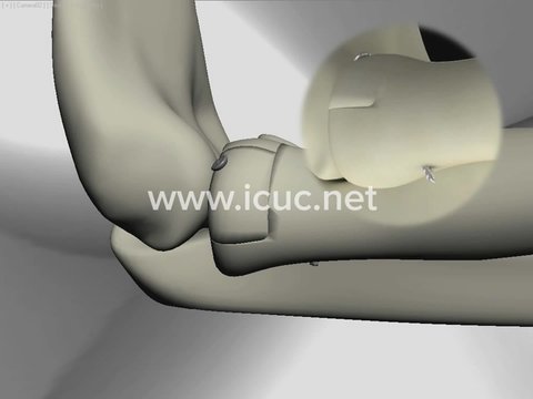 Proximal Forearm Tip and Trick on Protruding Screws | Vumedi