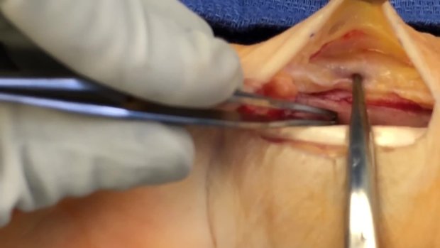 Distal Radius Fracture Repair Technique: Volar Plating | Vumedi