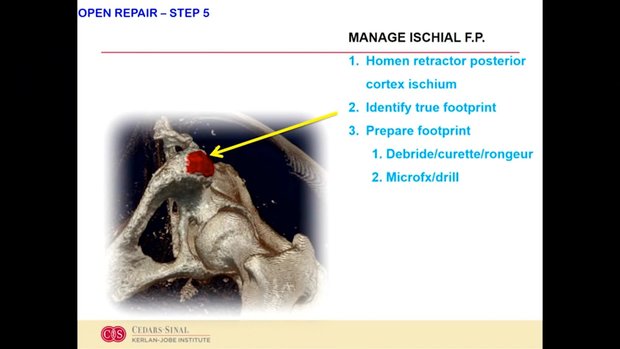 Innovative Technique for Endoscopic Repair of Proximal Hamstring ...