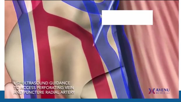 Percutaneous AVF Creation: A Promising New Technique? | Vumedi