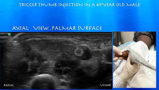Trigger Thumb Injection | Vumedi