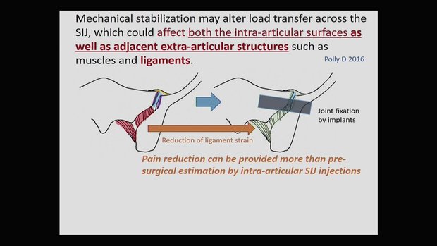 Value of SIJ Injections for the Diagnosis of SIJ Pain - pro | Vumedi