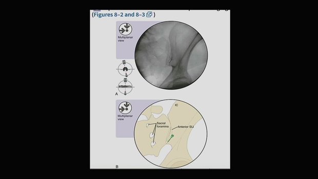 SIJ Injections - How To Do It (USA) | Vumedi