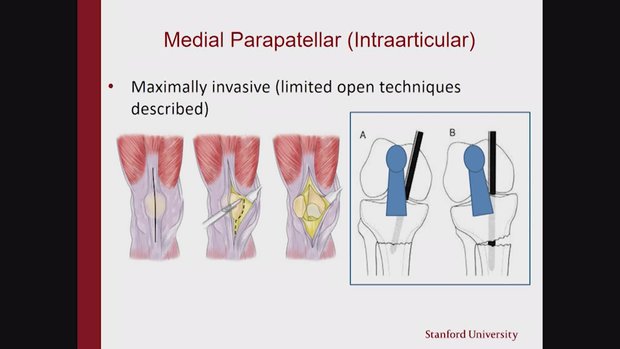 Suprapatellar vs. Standard Nailing of Tibial Shaft Fractures | Vumedi