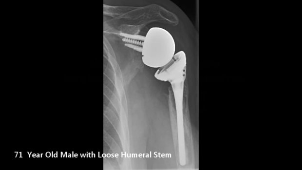 Allograft-Prosthetic Complex in Revision Shoulder Arthroplasty | Vumedi