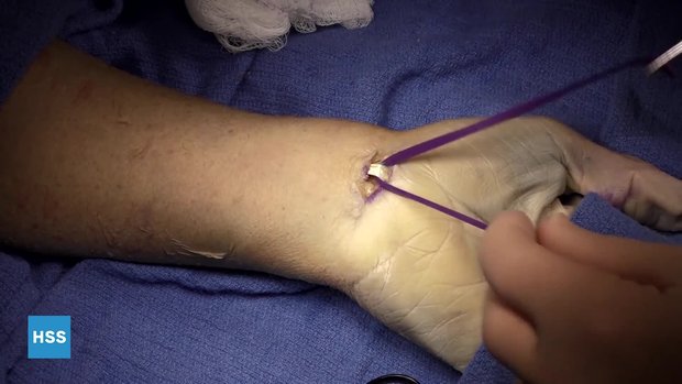 Two-incision Technique for Safe Harvest of the Palmaris Longus Tendon ...