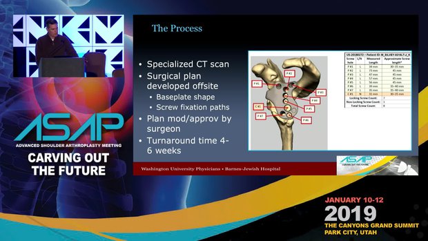 How I Use a Custom Patient Specific Base Plate | Vumedi