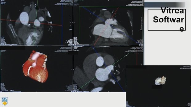 CT Screening for Watchman and Amulet LAA Closure: Step-by-step | Vumedi