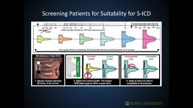 Subcutaneous ICDs: When and How | Vumedi
