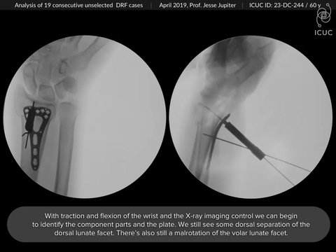 A Trend Towards Volar Approach on Dorsally Displaced Distal Radius ...