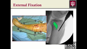 Proximal Tibia Fracture | VuMedi