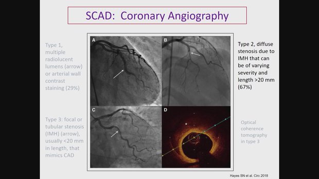 Spontaneous Coronary Artery Dissection (SCAD): Recognition and ...