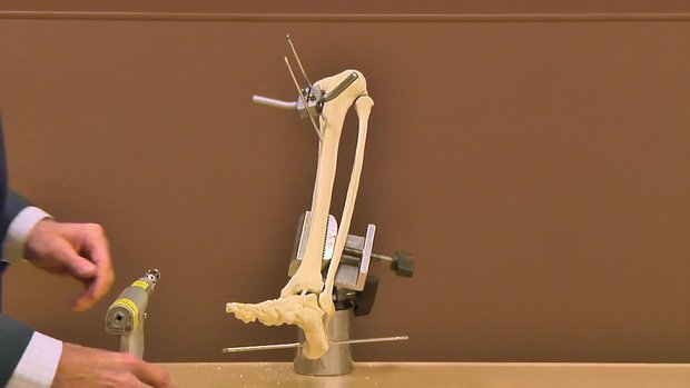 External Fixation Ankle Delta Frame Sawbones Demonstration | Vumedi