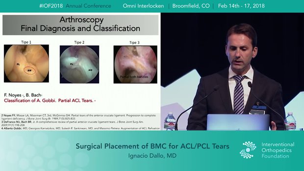 bpc 157 for torn acl The Hidden Risks of BPC157: What Patients Need to Know About Contamination and Safety Arthroscopic Implantation of BMAC and