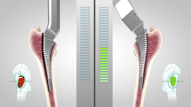 KINCISE™ Surgical Automated System - Broaching Animation | Vumedi