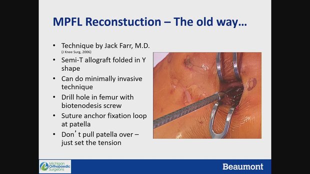MQTFL Reconstructions vs. MPFL: Pros & Cons | Vumedi