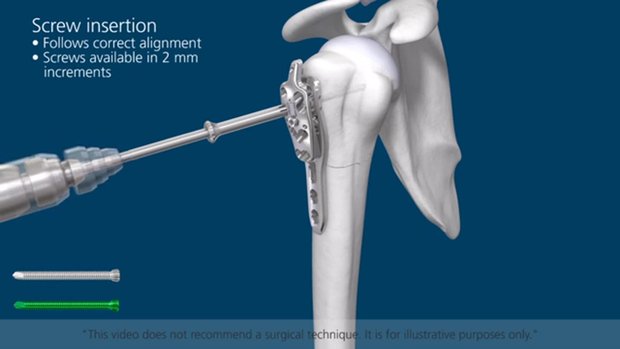 Proximal Humerus Solutions - System Overview Animation | Vumedi