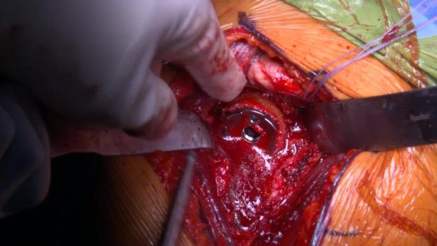 Bone grafting with RSA | Vumedi