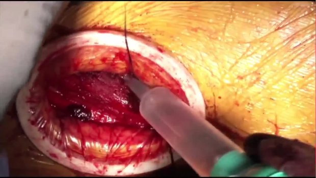 Capsular Closure After an Anterior Approach Hip Surgery | Vumedi