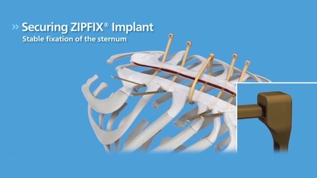 Sternal ZIPFIX® Animation Video | Vumedi