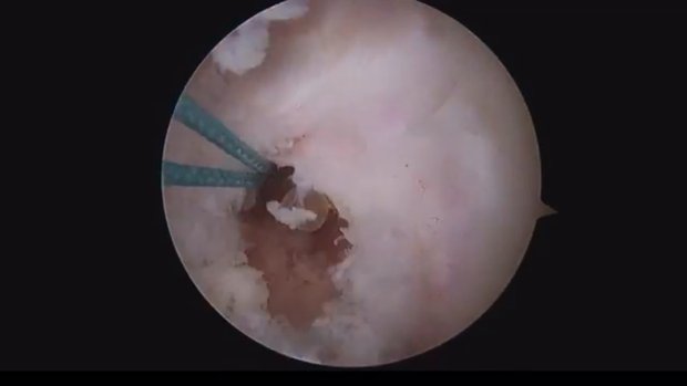 ACL Reconstruction Using Hamstrings Autograft | Vumedi