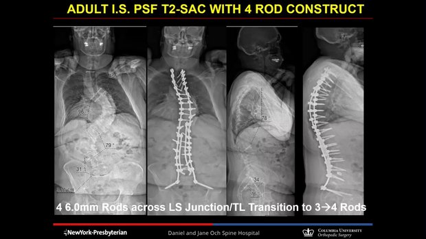 Multi-Rod Constructs for ASD: Why, When and How? | Vumedi