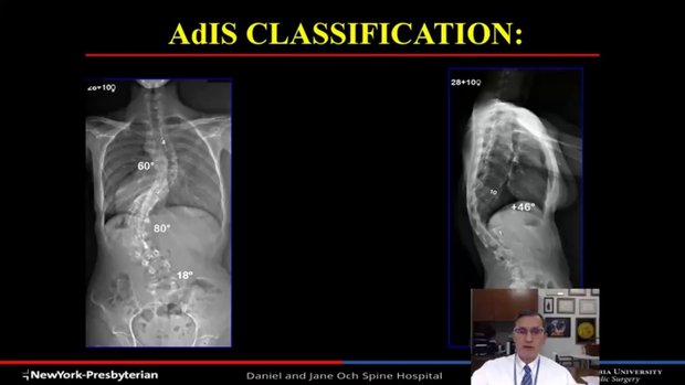 Adult Idiopathic Scoliosis (AdIS): a New Classification System and ...