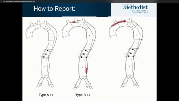 Type B Aortic Dissection: How to Classify it and Predict the Risks ...