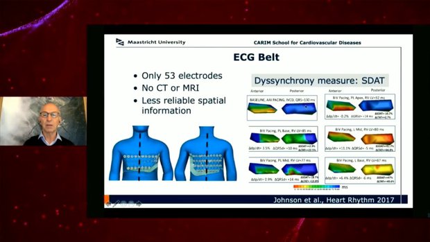 Novel Electrical Techniques to Assess Synchronization: ECG Imaging, ECG ...